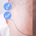 When Can You Return to Work After a Hair Transplant? A Guide for Patients