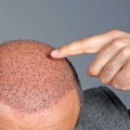 Everything You Need to Know About Hair Transplantation