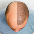 Affordable Hair Transplant Solutions: Financing and Payment Options Explained