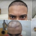 How Much Experience Does a Hair Transplant Clinic Staff Have?