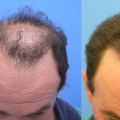 The Best Hair Transplant Solutions in Nashville: Get the Look You Deserve