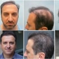 How Much Does a Hair Transplant Cost at a Clinic? - A Comprehensive Guide
