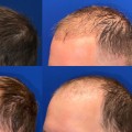 How Often Should I Visit the Hair Transplant Clinic for Follow-Up Appointments?