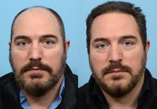 The Difference Between Hair Transplant and Hair Replacement: An Expert's Perspective