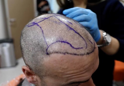 What Guarantees Does a Hair Transplant Clinic Offer?