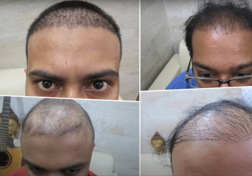 What is the Success Rate of Hair Transplants at a Clinic?
