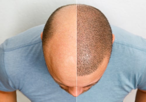What Aftercare Should You Expect from a Hair Transplant Clinic?
