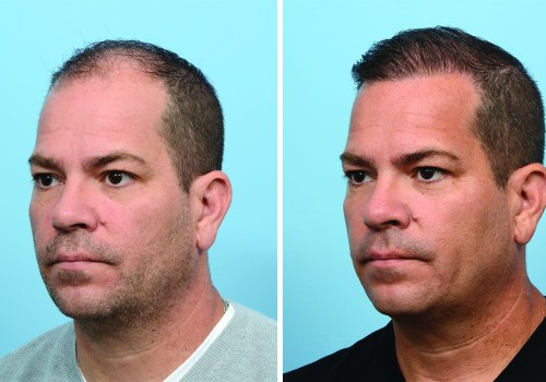 The Most Advanced Hair Transplant Technique: NeoGraft - A Comprehensive Guide
