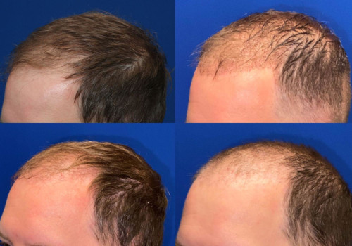 Does Transplanted Hair Fall Out After 2 Years?
