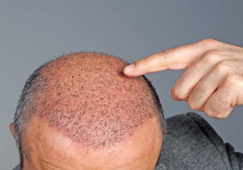 What Qualifications Should You Look for in a Hair Transplant Clinic?