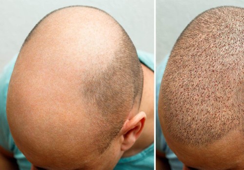 What Makes a Great Hair Transplant Surgeon? - An Expert's Perspective