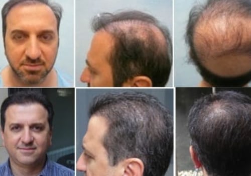 How Much Does a Hair Transplant Cost at a Clinic? - A Comprehensive Guide