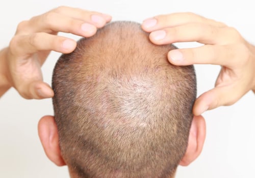 What Kind of Follow-Up Care is Provided After a Hair Transplant?